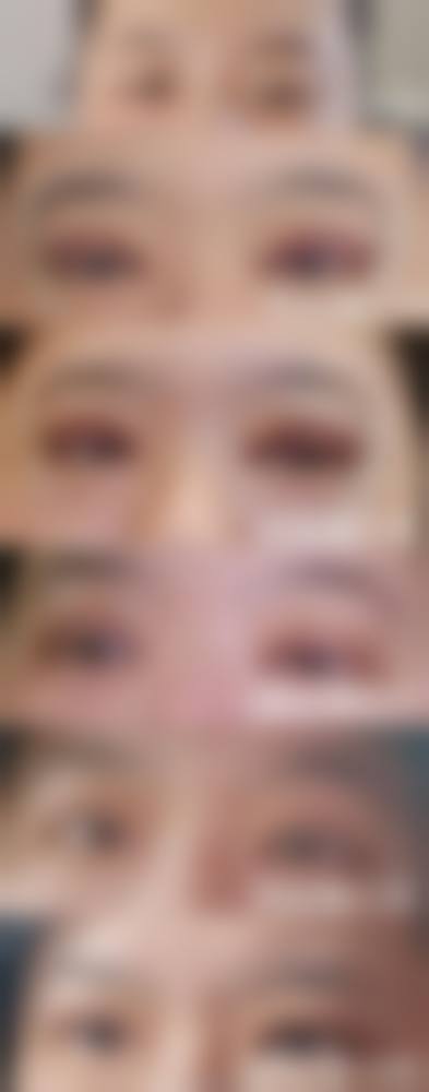 {韓國MINE雙眼皮自然嗎？2026最新術後實例大公開！女生必看自然度/對稱度評測避坑指南