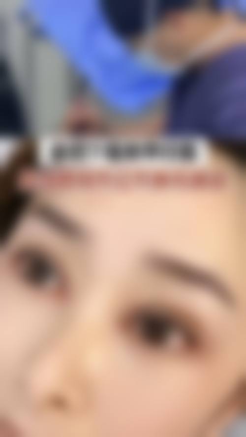 韓國MINE雙眼皮自然嗎:診所揀選3大關鍵(香港/澳門必睇)