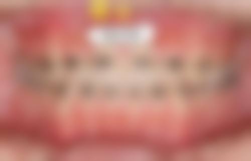 十、东莞雷四 医生擅长项目科普：隐形矫正