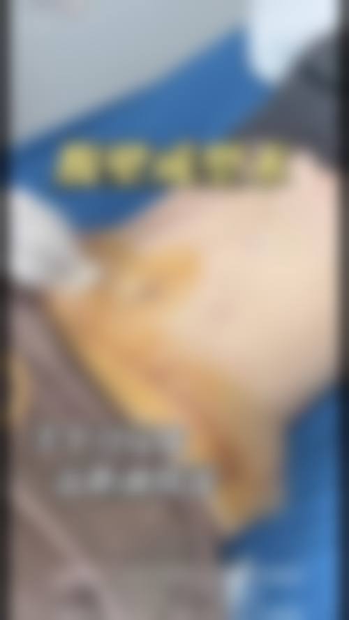 七、腰腹吸脂风险或注意事项