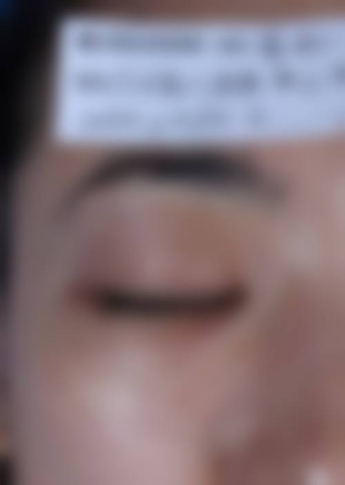 七、怎么判断自己是否适合去除红色疤痕