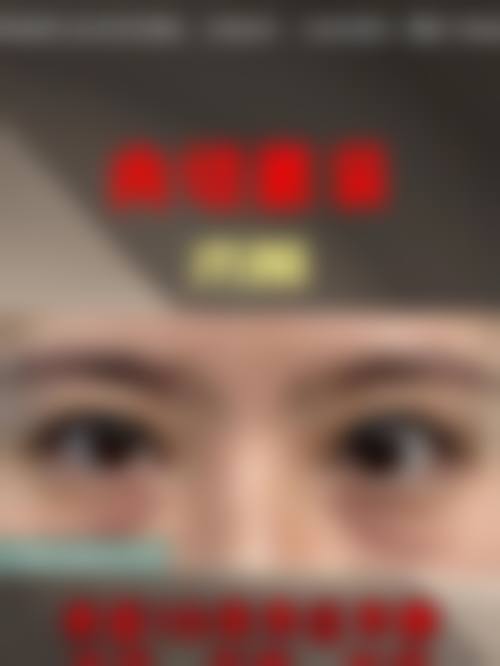 七、做双眼皮眼睛充血修复期间的护理要点