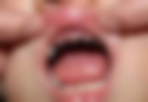 深圳瑞爾齒科箍牙推薦2026隱形矯正收費價錢大公開！真人案例效果點樣？