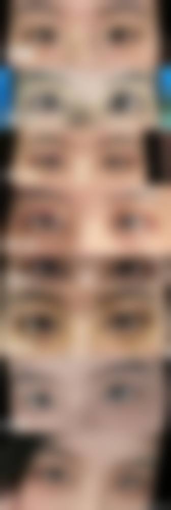 二、埋线修复全切双眼皮的可行性分析