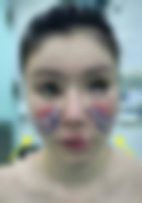 七、瘦脸针适合人群判断