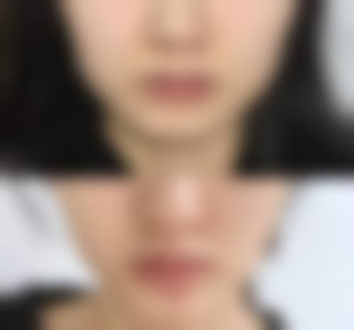 八、瘦脸针风险或注意事项