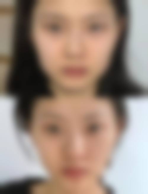 瘦脸针打深了有影响吗？医生揭秘注射深浅区别，过深或致面部僵硬！