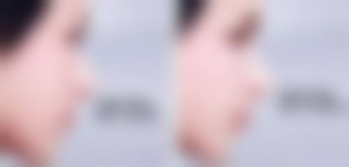 韓國醫美推薦法令紋:邊類人群更啱做?(附避坑指南)