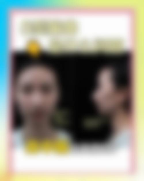 十、相关科普内容推荐——玻尿酸垫鼻基底
