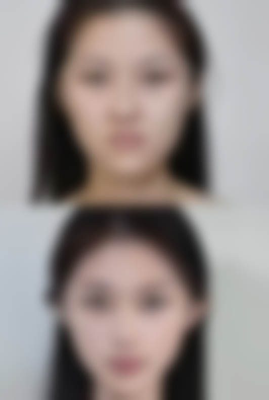 韓國醫美推薦法令紋2026：玻尿酸填充幾錢？院長親診分層注射唔使幾千蚊