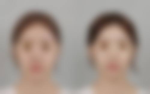 韓國橡皮擦皮膚科醫院價格表2026中韓報價 適合邊類人群?