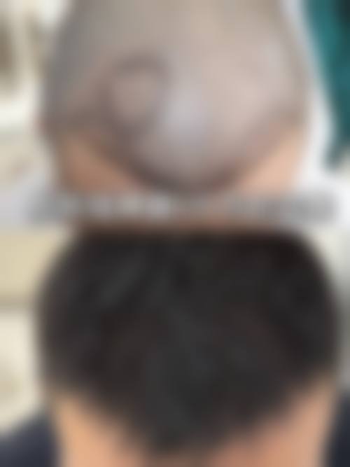 韓國毛傑琳植髮醫院怎麼預約掛號 關鍵選擇點(香港/澳門必睇)