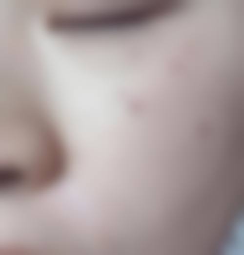 四、切痣留疤的风险