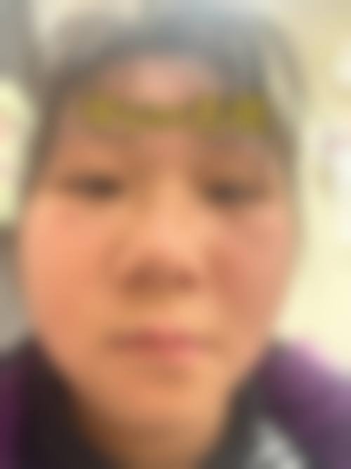 三、切痣留下的疤痕怎样消除