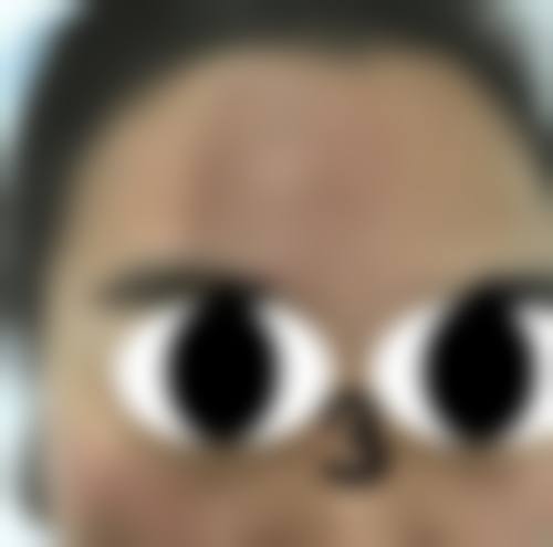 三、超脉冲点阵激光和普通点阵激光有什么区别,价格有差异吗?