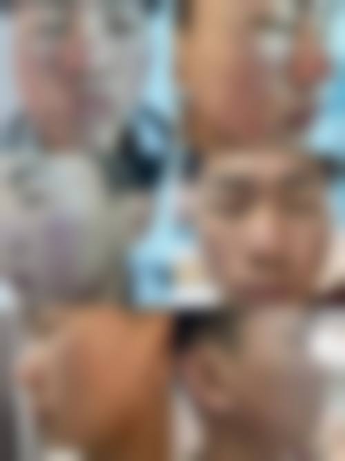 四、超脉冲点阵激光有哪些模式,不同模式价格一样吗?