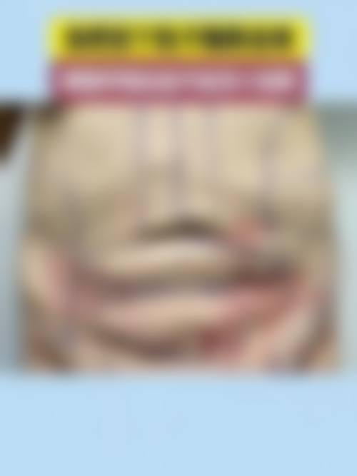 二、脸部吸脂一般多久可以消肿