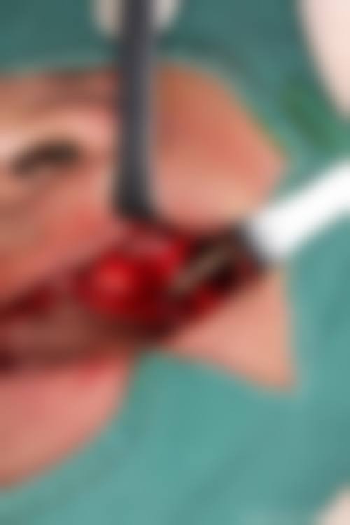 临床实例分享:真实实例见证党飞医生的技术实力