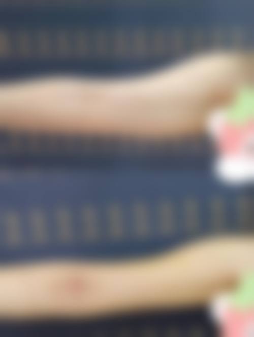 五、自体脂肪填充臂部价格背后的避坑要点