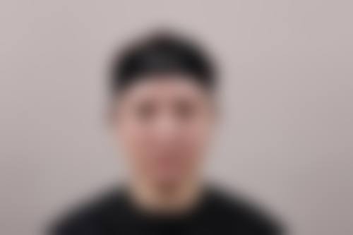 三、玻尿酸注射除皱的特点与适用情况