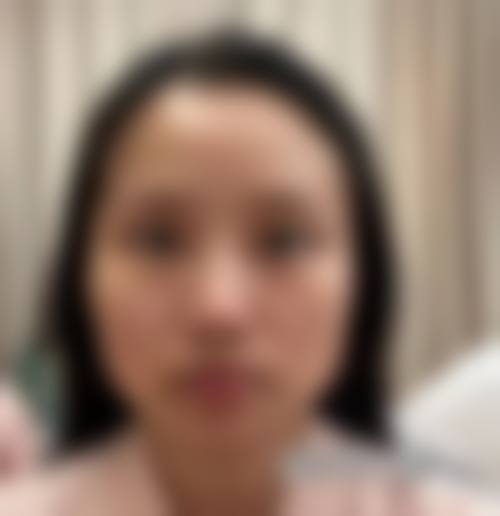 三、瘦脸针打后平躺时间受哪些因素影响?