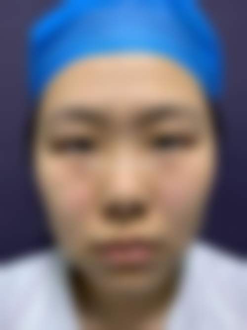 二、冻干粉对眼袋有成效吗