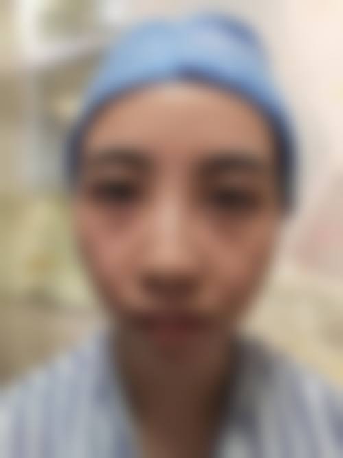 六、冻干眼膜和手术去眼袋的对比