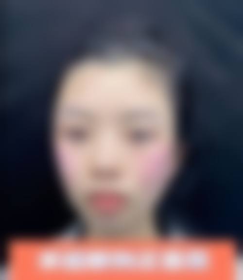 理性提醒:韓國輪廓手術唔係人人啱做!