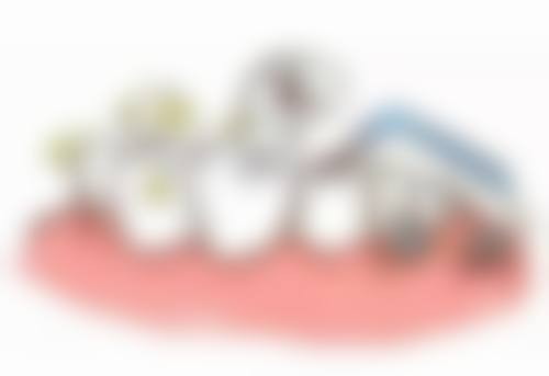 2. 格倫菲爾香港種牙技術:邊種更啱香港人?