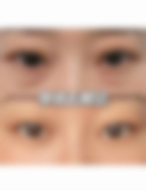 六、去除眼袋的风险与后遗症