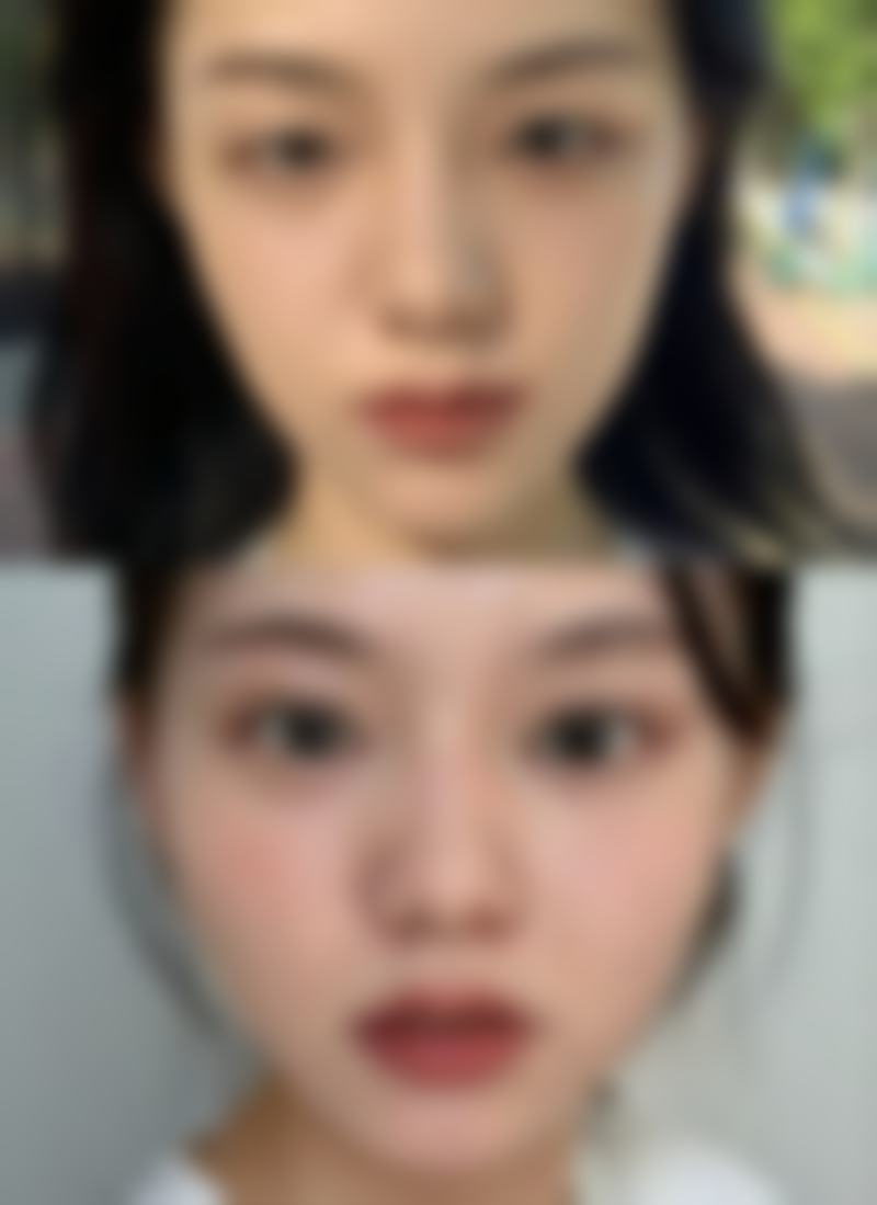 四、去除眼袋的成效对比