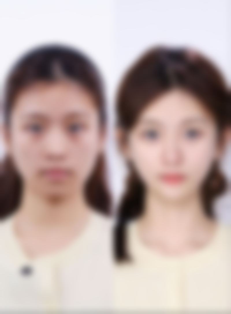 韓國男生去油縮毛孔醫美2026黃金微針點解咁爆?