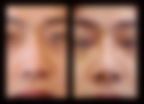 三、宽鼻矫正价格