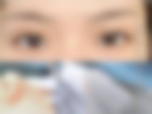韓國雙眼皮術後好腫正常嗎:港澳vs深圳/珠海價錢對比(2026全新)