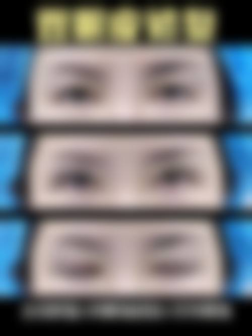 韓國雙眼皮術後恢復周期拆解:幾耐先可以返工見人?