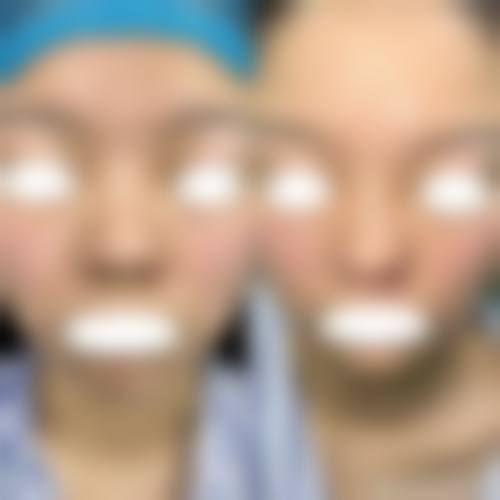 三、耳软骨隆鼻手术实例中的时间情况
