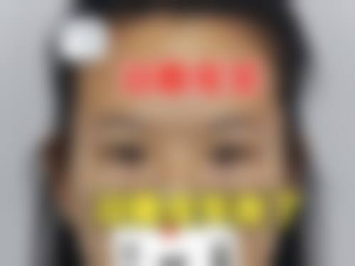 韓國雙眼皮術後消腫秘訣:醫生私藏+港澳姊妹實測有效