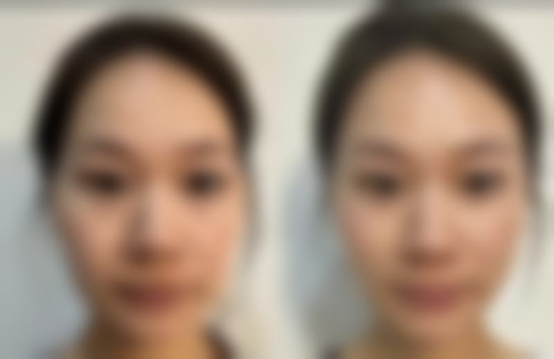 拓展延伸:痘疤治療真相 + 關鍵選擇點 + 避坑指南