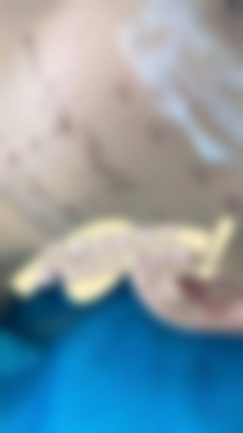 二、安多泰骨膜拉皮的操作方式与其它拉皮有何不同