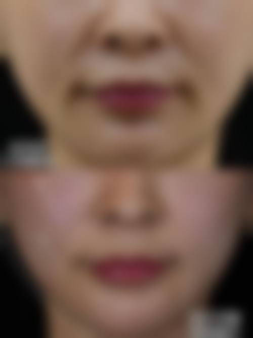 九、安多泰骨膜拉皮风险或注意事项