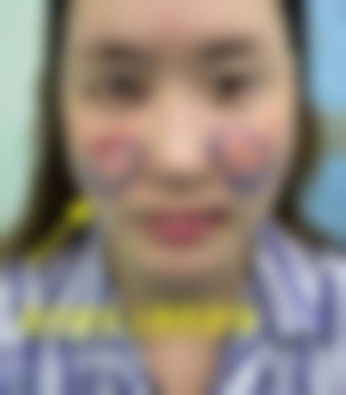 十、安多泰骨膜拉皮价格影响因素