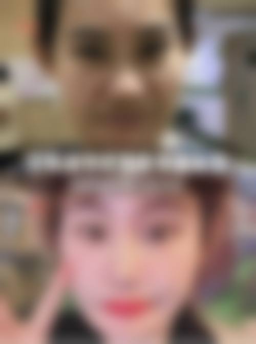 八、安多泰骨膜拉皮适合人群判断(怎么判断我是否适合安多泰骨膜拉皮项目?)