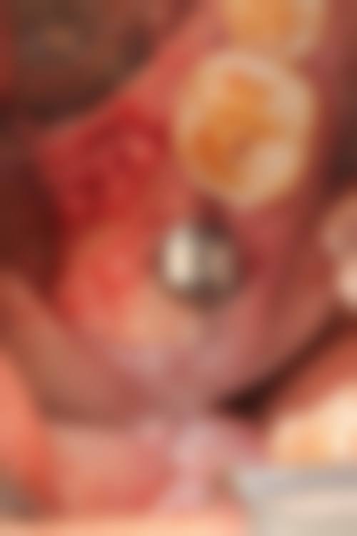 深圳河山口腔即拔即種好嗎？2026正規連鎖口碑好！收費親民技術如何？