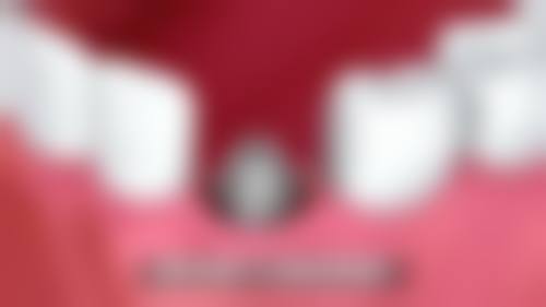 深圳河山口腔即拔即種好嗎:術前術後避坑指南!港澳姊妹必睇